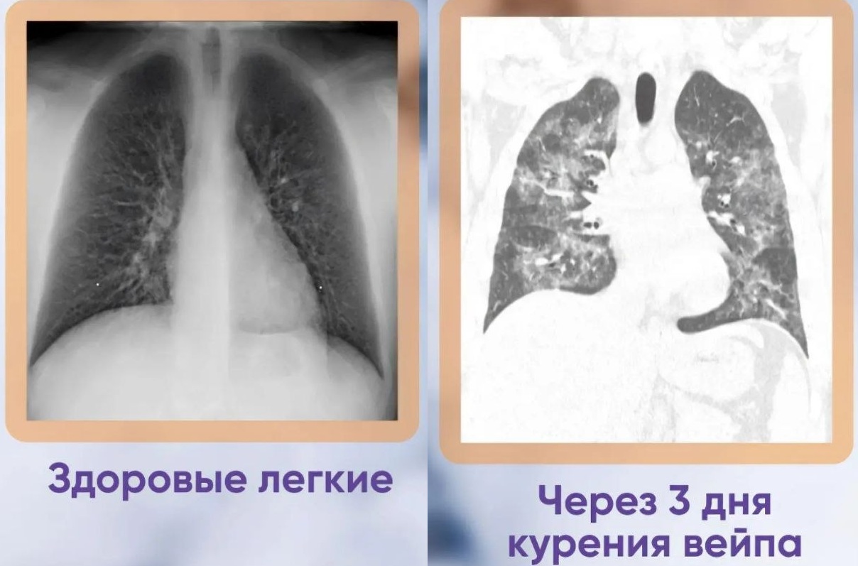Курение вейпа лишило 19-летнего саратовца части лёгких